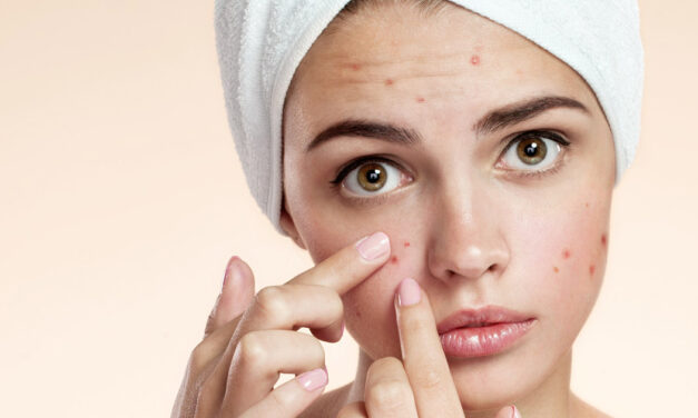 Ακμή | Ποιες Τροφές να Αποφύγεις;