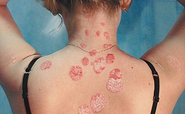 Τι είναι η Ψωρίαση και ποια τα Αίτιά της;